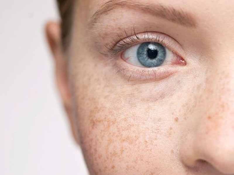 dermapen leke tedavisi