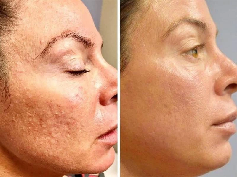 melasma lekeleri