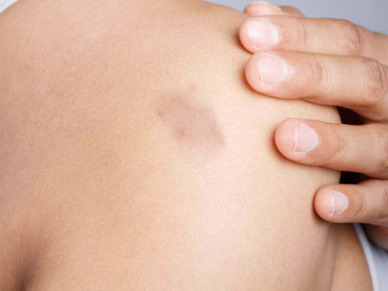 keloid nedir